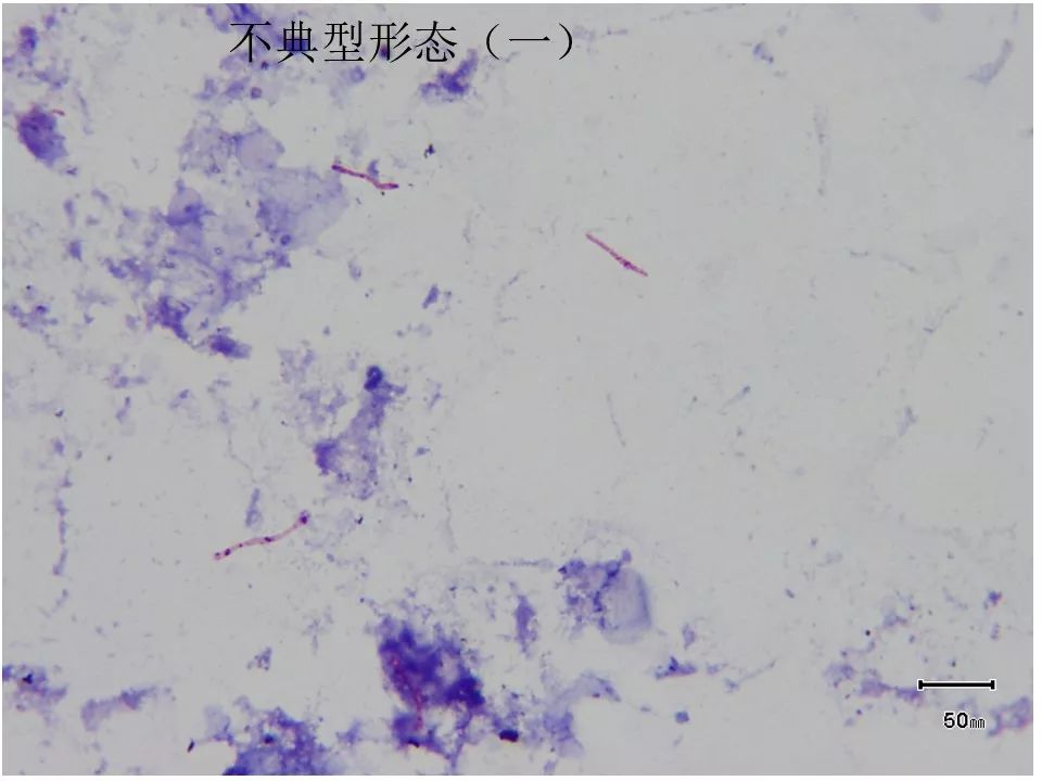 如何提高临床标本中抗酸杆菌涂片阳性率