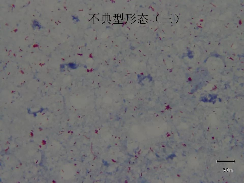 如何提高临床标本中抗酸杆菌涂片阳性率