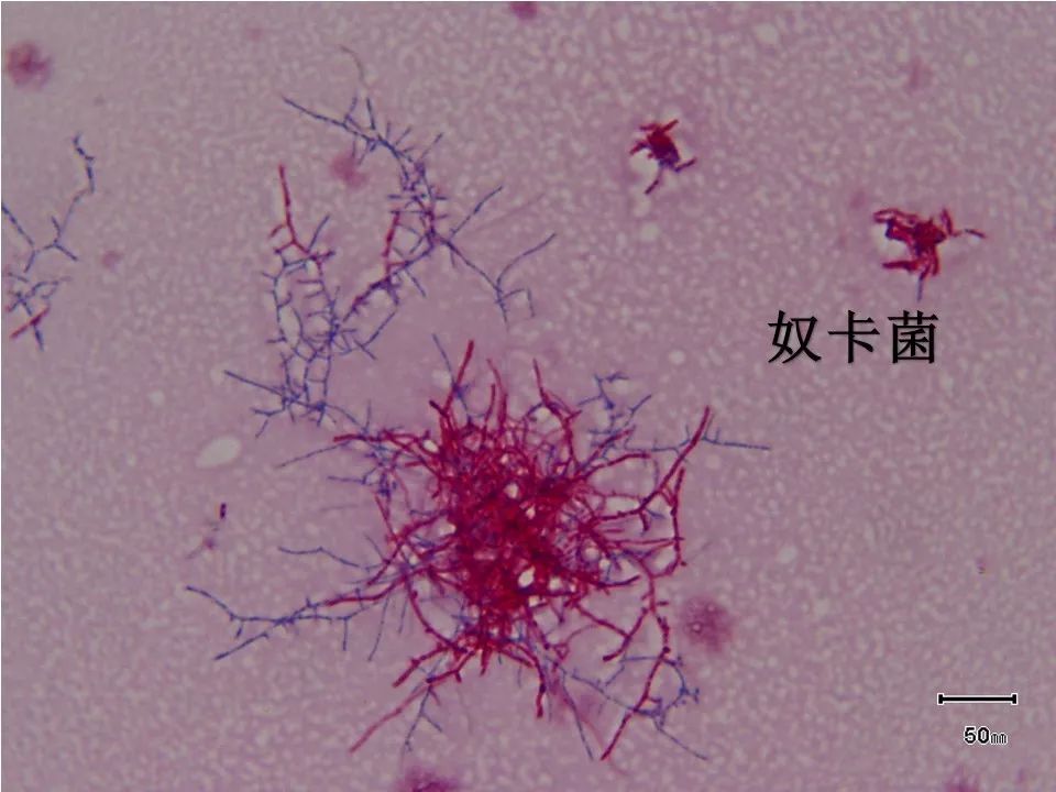 如何提高临床标本中抗酸杆菌涂片阳性率