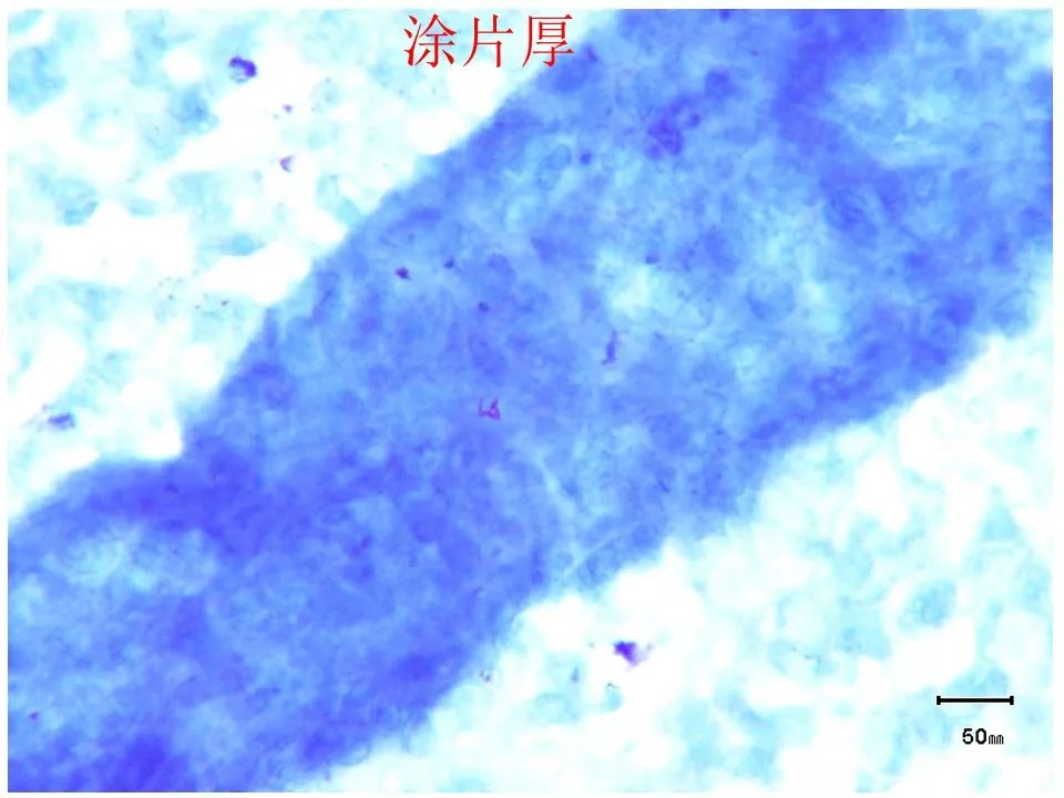 如何提高临床标本中抗酸杆菌涂片阳性率