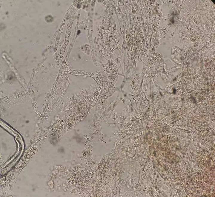 细胞核增大,背景散在少数淋巴细胞,符合真菌感染(曲霉菌可能性大)
