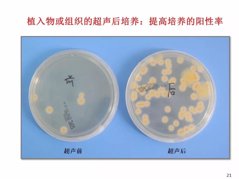 慧眼识菌诺卡菌致起搏器囊袋感染一例